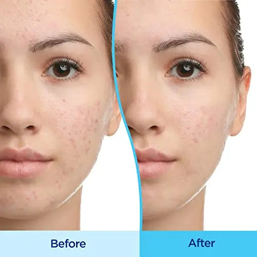Differin Acne Treatment Gel, 90 Day Supply, Retinoid Treatment For Face Differin Au supplements