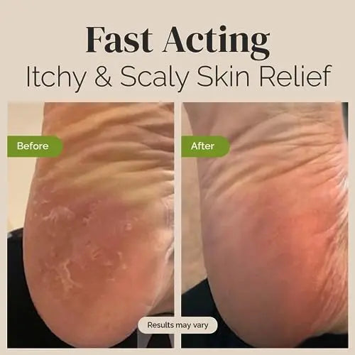 Tea Tree Oil Balm , Extra Strength, Pair Well with Jock Itch Cream, Spray, Athletes Foot Puriya Au supplements