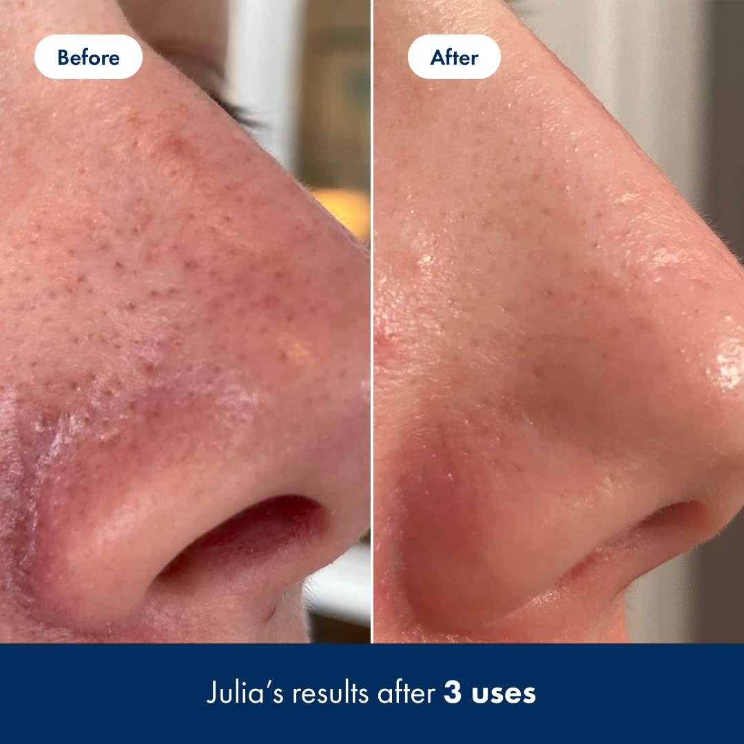 Hero Cosmetics Pore Release Blackhead Clearing Solution - Exfoliating Toner Featuring BHA HERO COSMETICS Au supplements