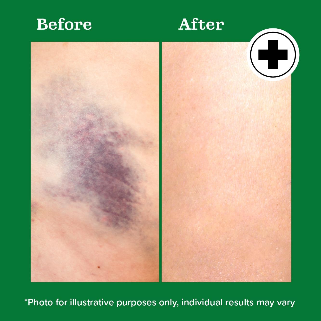Miracle Plus Natural Arnica Bruise Gel For Body | Skin Care Arnica Montana Lotion Topical Gel | Extra Strength Vitamin K Cream Ointment, 4 Fl Oz Miracle Plus Au supplements