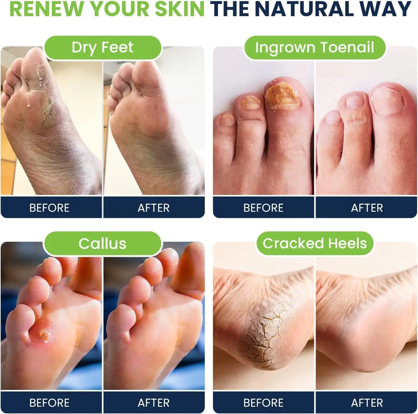 Tea Tree Oil & Citrus Detox Foot Soak with Epsom Salts - All Natural Salts for Post Workout FOOT CURE Au supplements