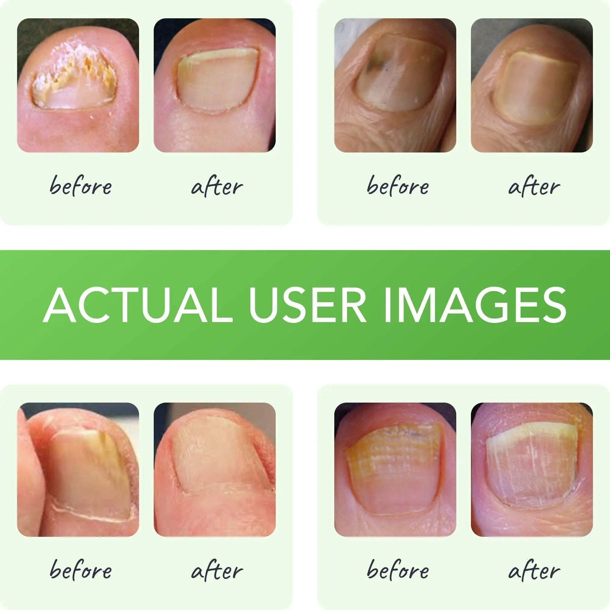 FUNGINIX Healthy Nail Formula - Finger And Toe Fungus Treatment, Made In USA, Foot FUNGINIX Au supplements