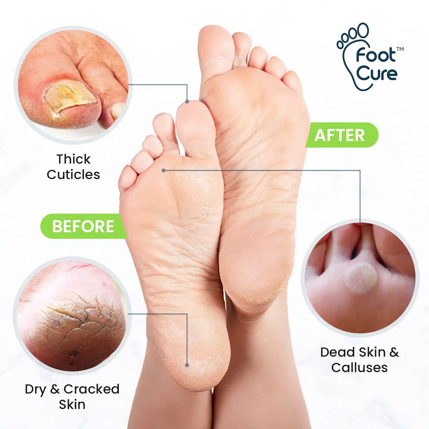 Toenail Fungus Treatment Extra Strength - Advance nail fungus treatment for fingernails FOOT CURE Au supplements