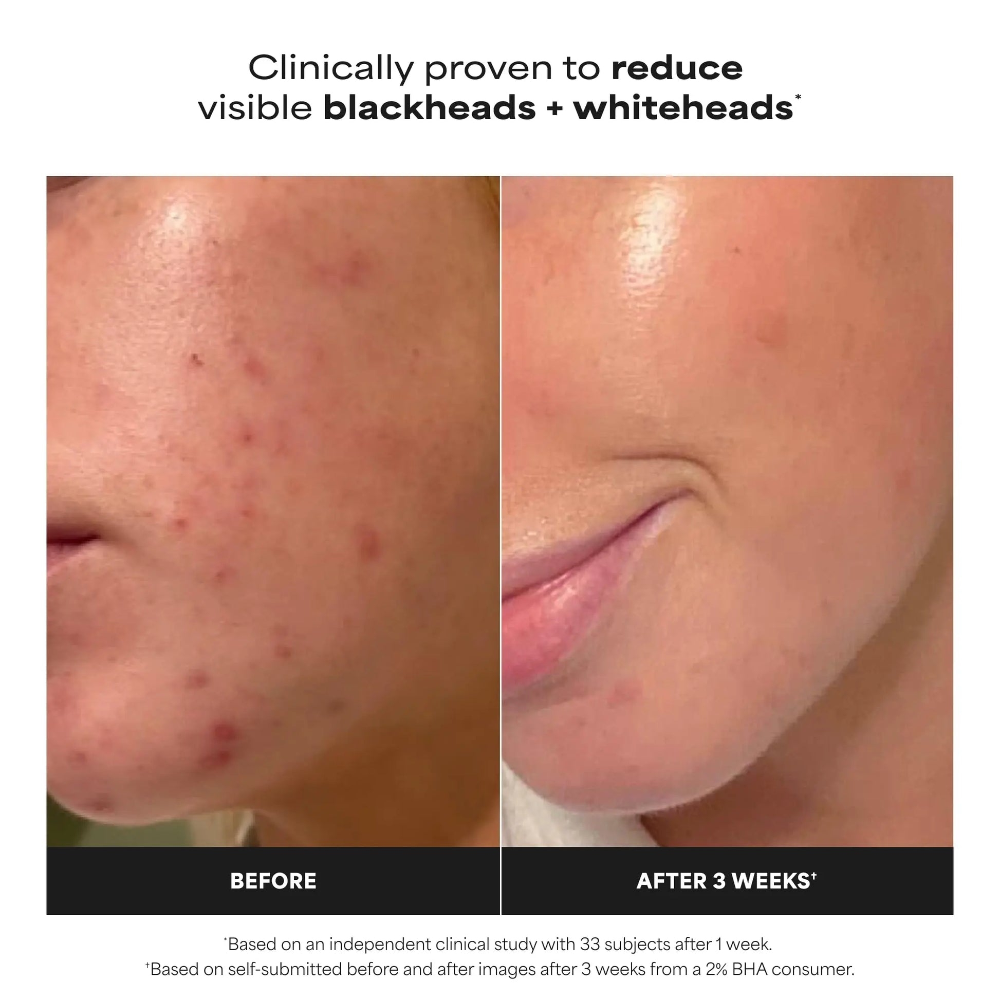 Paulas Choice--SKIN PERFECTING 2% BHA Liquid Salicylic Acid Exfoliant--Facial Exfoliant Paula's Choice Au supplements