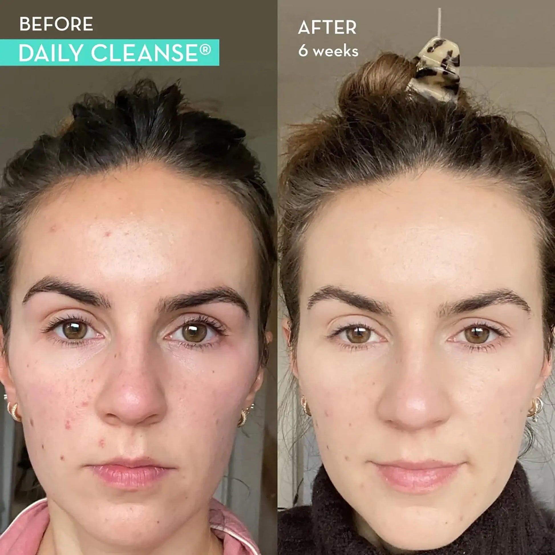 HUM Daily Cleanse Acne Supplements - Support for Clear Skin & Improved Digestion HUM Au supplements