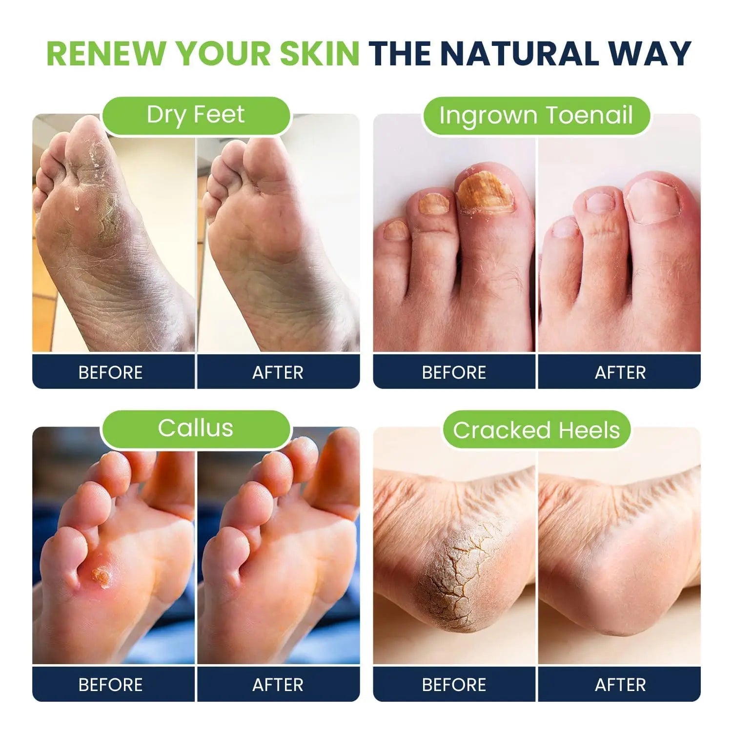 Tea Tree Oil Foot Soak with Epsom Salt - Best Toenail Fungus Treatment, Athletes FOOT CURE Au supplements