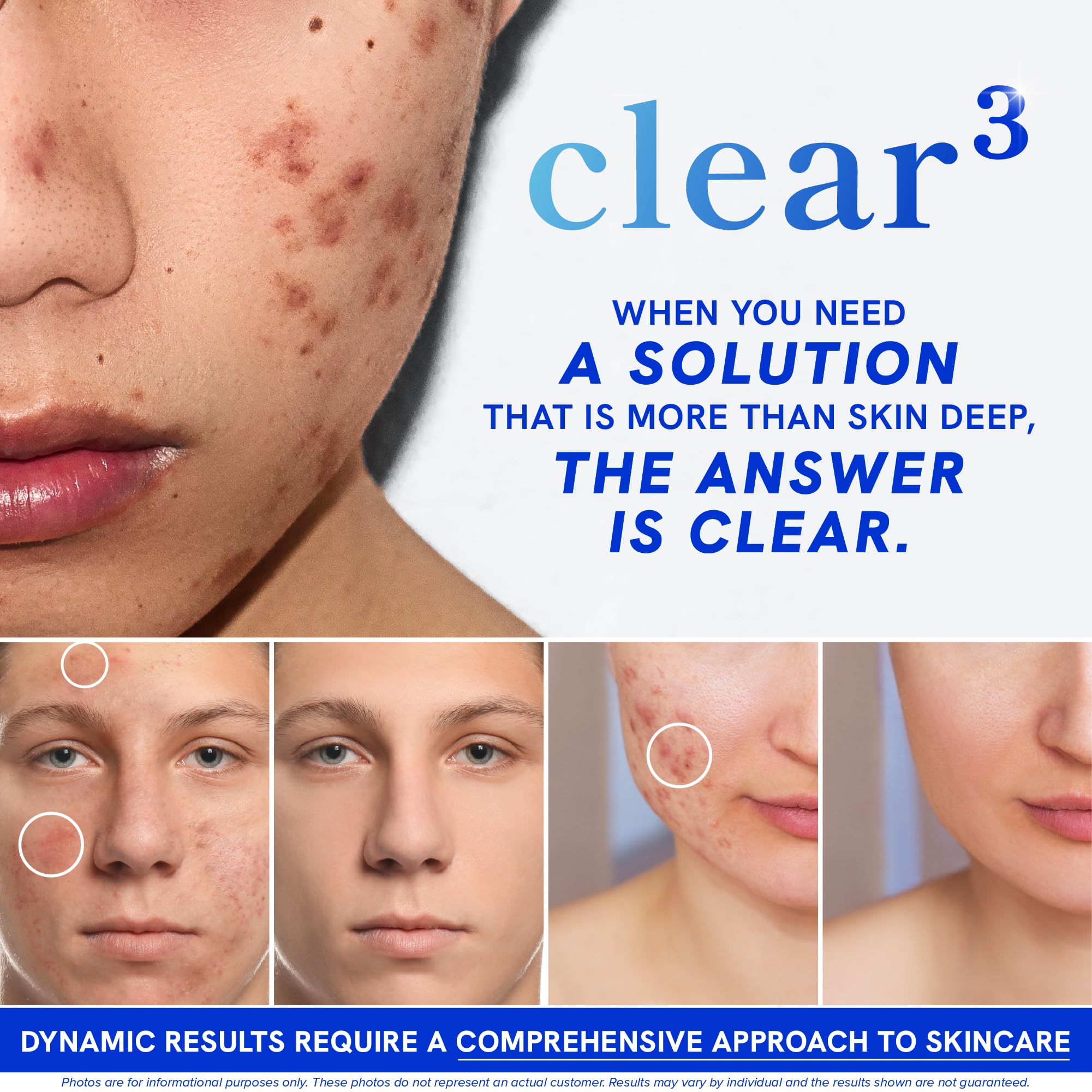 Clear Skin Supplement with Zinc, DIM & Probiotics | 3-in-1 Balance, Glow & Health Skin Support | Triple Action Hyaluronic Acid, Niaciminide & Vitamins for Hormone, Complexion & Gut Support | 180 Ct SMNutrition Au supplements