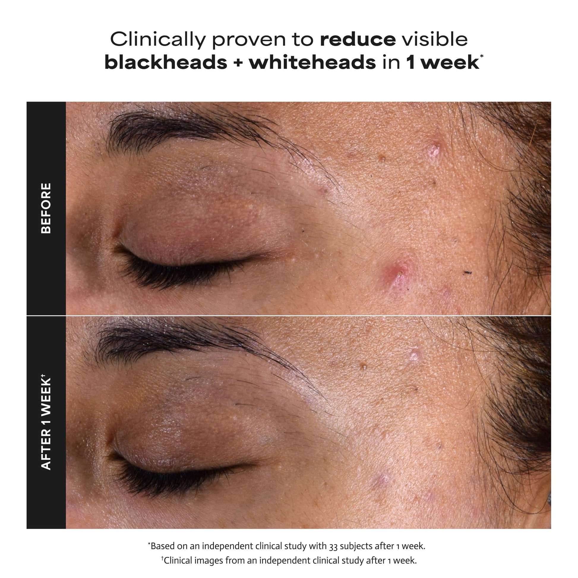 Paulas Choice--SKIN PERFECTING 2% BHA Liquid Salicylic Acid Exfoliant--Facial Exfoliant for Blackheads, Enlarged Pores, Wrinkles & Fine Lines, 4 oz Bottle Paula's Choice Au supplements