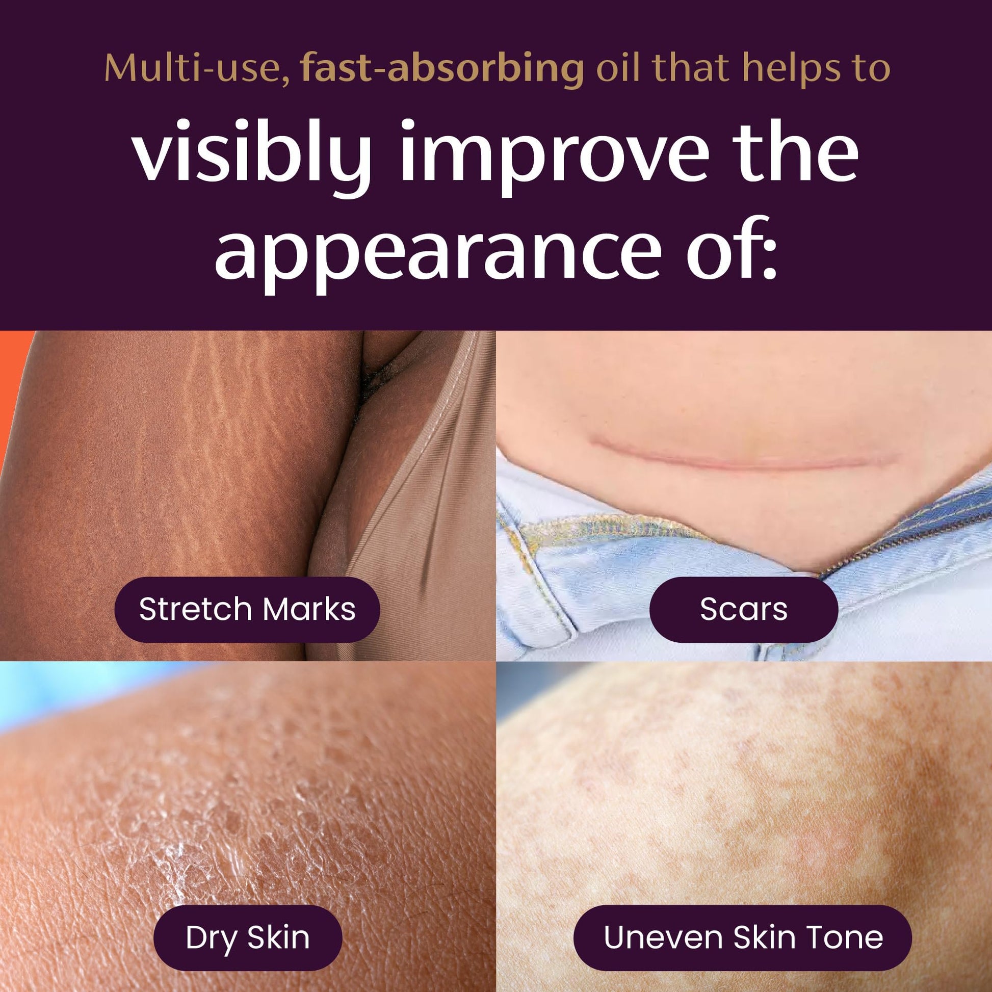 Mederma Quick Dry Oil, Scar and Stretch Mark Treatment, Helps to Improve the Appearance with Natural Botanical Extracts, Paraben Free, Fast-Absorbing, 3.4oz (100ml) Mederma Au supplements