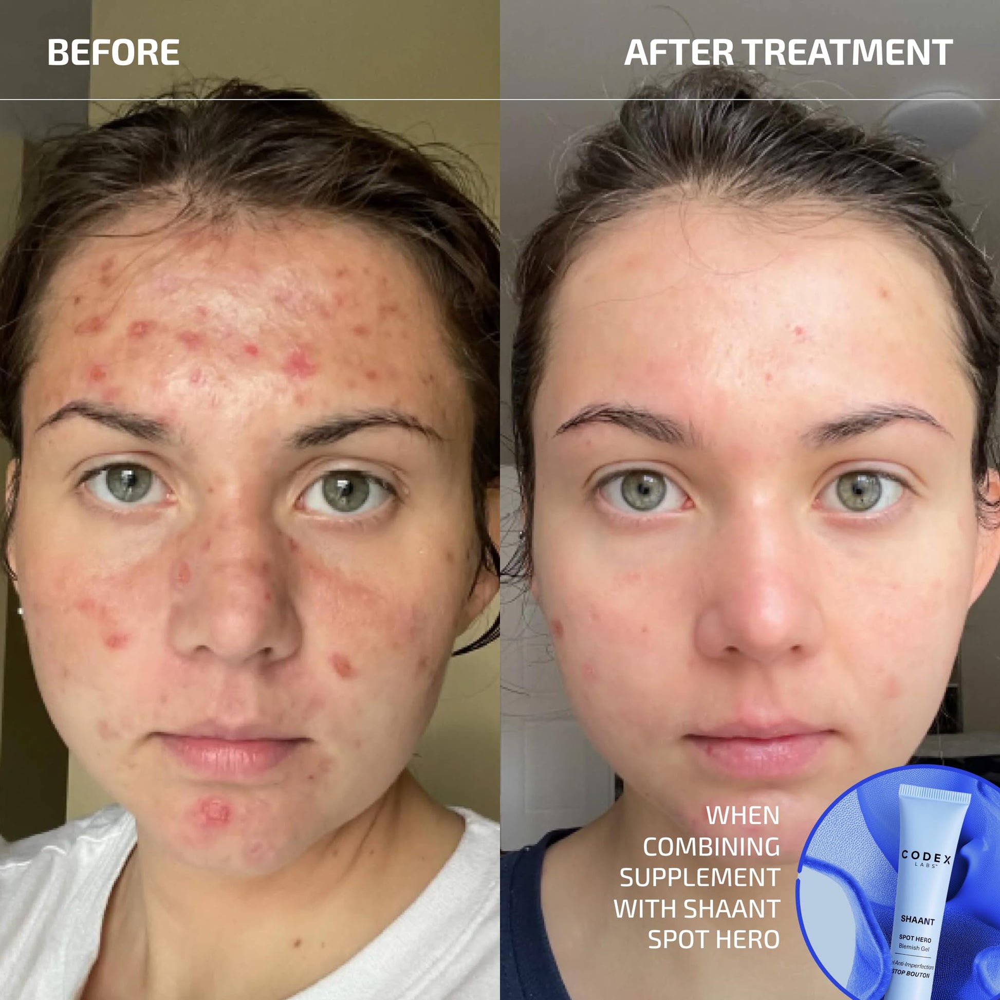 Codex Labs Shaant Clear Skin Supplement – 60 Vegan Capsules | Acne Probiotics with 9-Strain Blend, Green Tea EGCG & Guggul – Daily Support for Acne-Prone Skin & Clear Complexion Codex Labs Au supplements